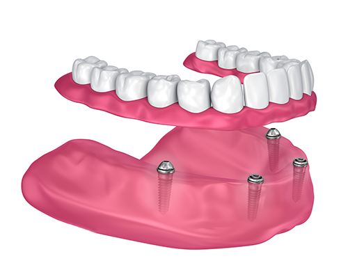 Implant-supported dentures model