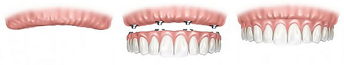 Implant supported dentures graphic