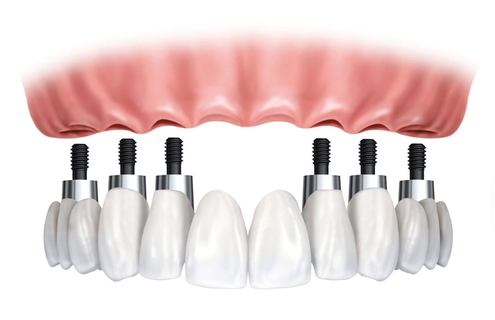 Implant-supported dentures illustration