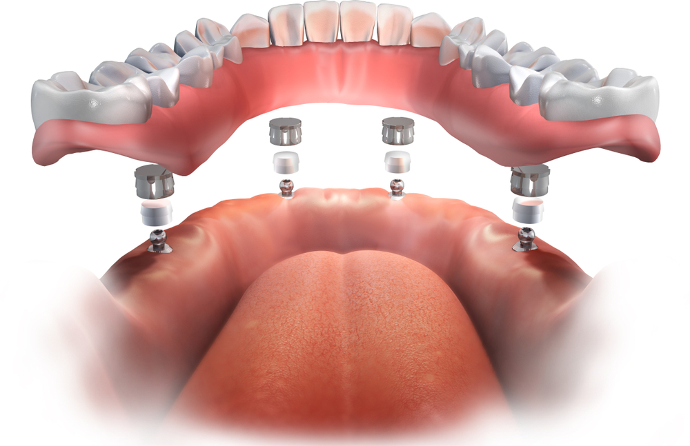 Implant-supported dentures illustration
