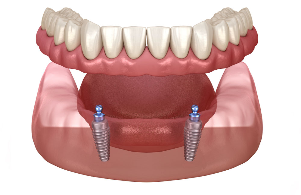 Implant-supported dentures illustration