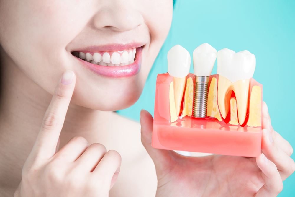 A woman holds up a model to show the dental implant process for a single tooth dental implant