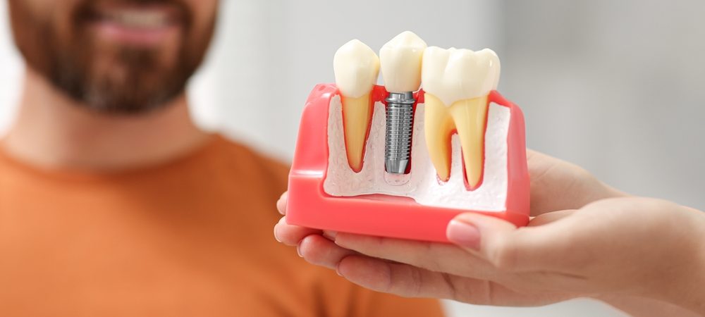a man examines a model of dental implants to understand why he needs supplemental procedures and choose the best of the tooth replacement options
